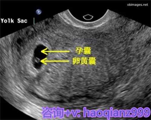 北京助孕价格妈妈为不孕夫妇提供的试管代怀代生服务详解